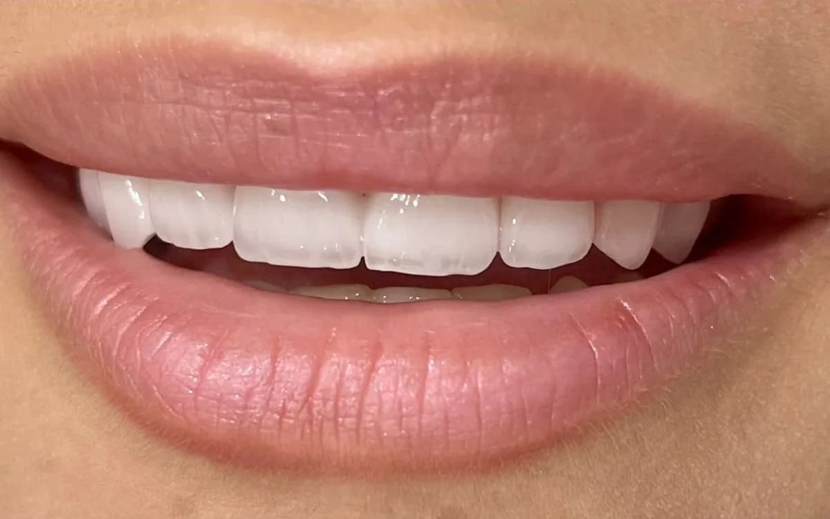 بعد: ترميم تجميلي للابتسامة — تيجان خزفية