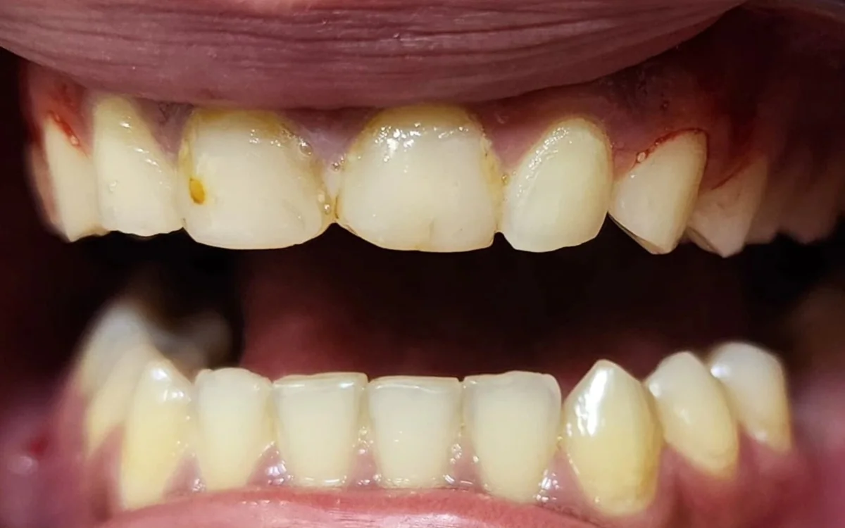 قبل: ترميم تجميلي للابتسامة — تيجان خزفية